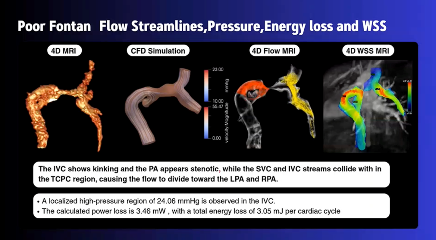 4D Flow MRI และการจำลองการไหลเวียนเลือด